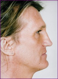 Before facial feminisation